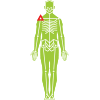 Sciatica Radiculopathy example